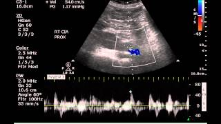 Duplex Examination of an Aortic Aneurysm  Case Study [upl. by Lotsyrk]