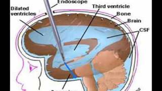 Hydrocephalus [upl. by Neelram]