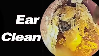 Ear Picking丨Ears That Havent Been Cleaned In 10 Years The Earwax Turned Into Black Stones丨ASMR [upl. by Euqinwahs561]