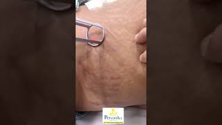 How to Remove Stretch Marks Using Vicks Vaporub  SuperWowStyle Prachi [upl. by Akins]