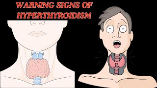 Warning Signs of Hyperthyroidism  Hyperthyroidism Symptoms [upl. by Radke]