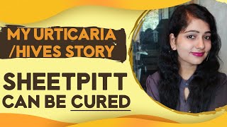 Urticaria My Story Symptoms Causes Cure and Treatment for UrticariaHives Sheetpitt [upl. by Akeyla]