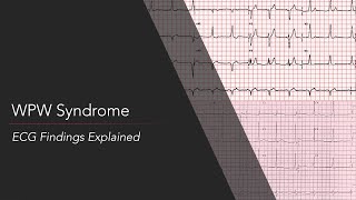 WolffParkinsonWhite WPW Syndrome ECG [upl. by Adai618]