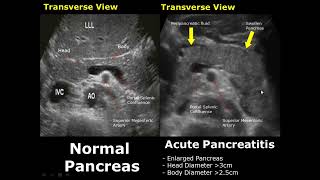 Pancreas Ultrasound Normal Vs Abnormal Image Appearances Comparison  Pancreatic Pathologies USG [upl. by Heisel962]