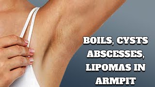 Common Causes of Pain amp Lumps in Armpit  Boils Cysts Lipomas [upl. by Halbert384]