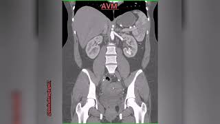 AVMArteriovenous malformations in left kidney [upl. by Navetse]