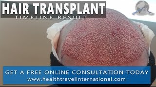 FUE Hair Transplant – 12 Month Timeline Result  Hair loss treatment  Receding hairline Men 2017 [upl. by Giacomo497]