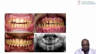 Dr Karthik Department of Oral Medicine amp Radiology Anomalies of tooth [upl. by Raina705]