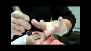 Dermapen Scottsdale AZ Practioner showing Micro Needling SkinPen Thearpy [upl. by Annovad]