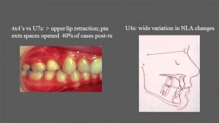 Treatment and stability of Class II Division 2 malocclusion in children and adolescents [upl. by Neevan]