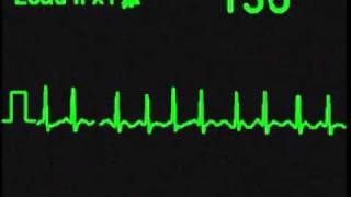 Atrial Fibrillation  AFIB  ECG Simulator  Arrhythmia Simulator [upl. by Rusert]