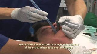 Intubation Extubation 47 [upl. by Stevie]