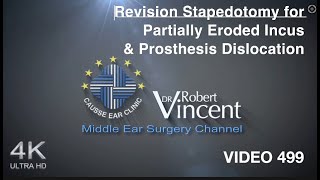 Revision Stapedotomy for Partially Eroded Incus amp Prosthesis Dislocation [upl. by Nerek480]