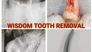 HOW TO REMOVE WISDOM TOOTH AND RCT TREATED TOOTH USING COUPLAND ELEVATOR [upl. by Mauralia]