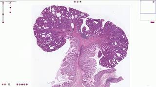 Tubular adenoma  Colon  Histopathology [upl. by Emirak]