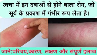 photosensitive eruption eczema disease फोटोसुग्रहित विस्फोट छाजन रोग का कारण लक्षण और संपूर्ण इलाज [upl. by Ahsenahs]