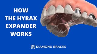 How The Hyrax Expander Works [upl. by Aggappe229]