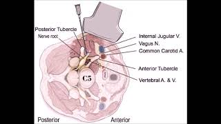 UltrasoundGuided Injection to the Fifth Cervical Spine Nerve Root Level [upl. by Atirac]