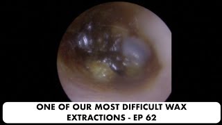 ONE OF OUR MOST DIFFICULT EAR WAX REMOVALS  EP 62 [upl. by Sibelle]