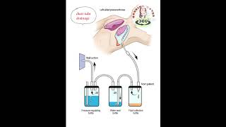 Chest tube drainage nursingnotes360° pneumothorax music nursing [upl. by Saw]