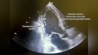 Low Ejection Fraction Низкая фракция выброса [upl. by Steffane]