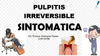 Pulpitis Irreversible Sintomática aguda o subaguda [upl. by Alemaj]