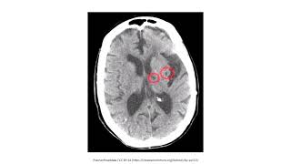 Cerebrovascular Disease for the USMLE Step 1 [upl. by Atirres]