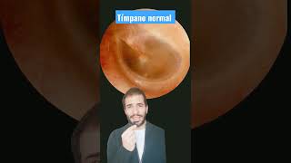 ¿cuánto tiempo tarda en cicatrizar un tímpano perforado por una otitis [upl. by Cyrille]