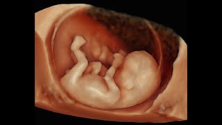 How to Perform 3D Scan of the Baby at 12 Weeks of Pregnancy [upl. by Hizar]