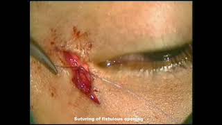 Lacrimal Fistula Repair [upl. by Aisinoid]