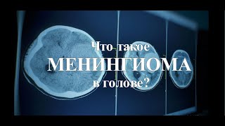 Что такое внутричерепная менингиома [upl. by Heydon367]