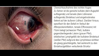 Beidseitige Bindehautentzündung Konjunktivitis im Verlauf einer Affenpockeninfektion [upl. by Rokach63]