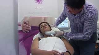 Ultraformer  Nonsurgical Face and Neck Lifting [upl. by Amilas]