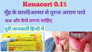 Kenacart 01 Oral Paste Use in Hindi Kenacort gel ke fayde मुँह के छालों से जल्द आराम दिलाये use [upl. by Ika594]