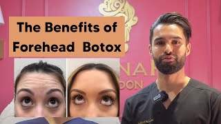 Benefits of Forehead Botox [upl. by Sarazen]