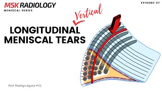 Longitudinal Vertical Meniscal Tear on MRI [upl. by Jeana]