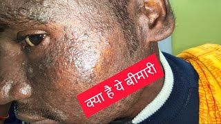 Darier White Disease  DWD  keratosis follicularis  Dr Anshuman Telang MD [upl. by Beore]