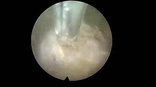 Endoscopic Rhizotomy  Dr Kevin P McCarthy [upl. by Dranik]