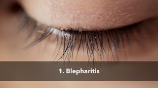 1 Blepharitis [upl. by Delbert]