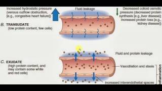 PATHOLOGY LECTURES  Hemodynamic Disorder  EXUDATES and TRANSUDATES [upl. by Drareg309]