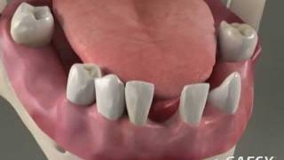 Dentures Overdentures  Roseville Dentist [upl. by Marni]