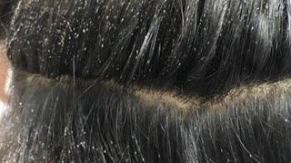 lice hair treatment 🥶kisi ko bhi krvana ho to mujhe comment me likhe 💯results 👍 [upl. by Rea]