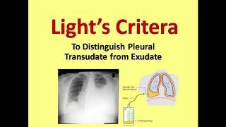 Lights Criteria for Distinguishing Transudate from Exudate [upl. by Aerdnahc9]