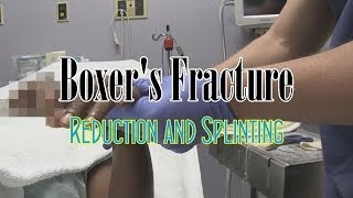 Boxers Fracture Reduction and Splinting [upl. by Wittie]