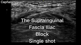 The Suprainguinal Fascia Iliac Block in the Emergency Department [upl. by Eiclehc318]