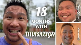 18 MONTHS SMILE PROGRESS WITH INVISALIGN  Invisalign Journal [upl. by Anelas]