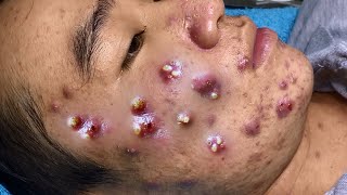 Big Cystic Acne Blackheads Extraction Blackheads amp Milia Whiteheads Removal Pimple Popping 054 [upl. by Ayhtnic929]