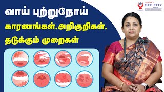 வாய் புற்றுநோய் காரணங்கள் அறிகுறிகள்தடுக்கும் முறைகள்  Oral Cancer [upl. by Alvan422]