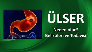 ÜLSER NEDİR NASIL TEDAVİ EDİLİR [upl. by Brelje]