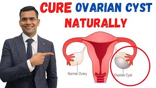 Just 3 Recommendations To Cure Ovarian Cyst Naturally  Dr Vivek Joshi [upl. by Guadalupe]